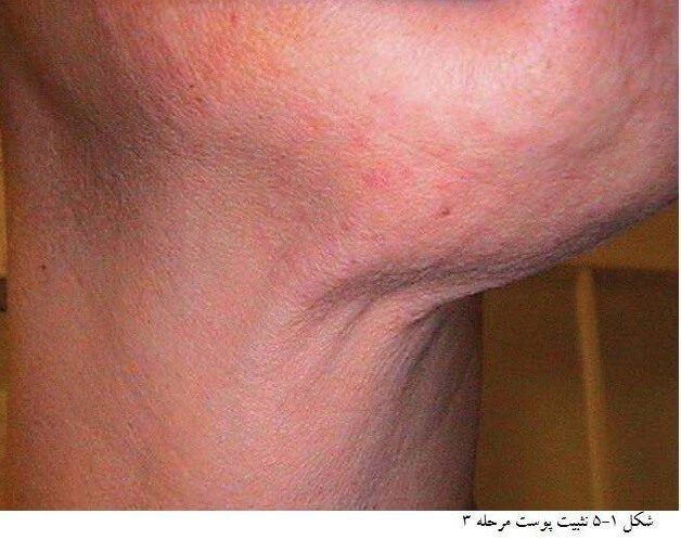 مزوتراپی در جوانسازی پوست